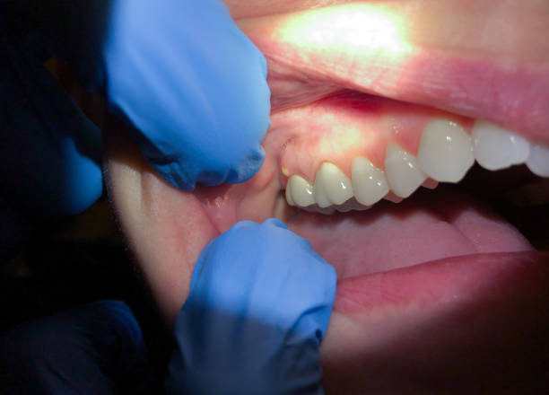 Best Emergency Dentist for Knocked-Out Tooth in Dade City North, FL